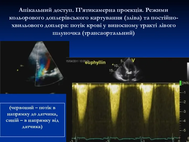 Апікальний доступ. П’ятикамерна проекція. Режими кольорового доплерівського картування (зліва) та