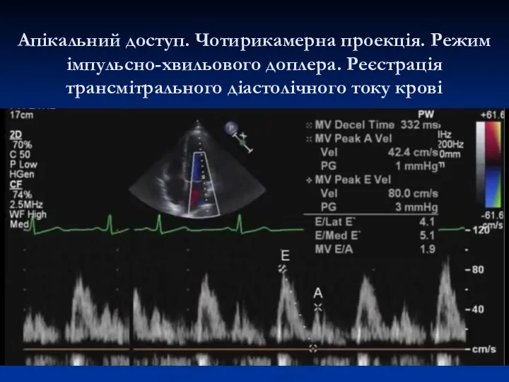 Апікальний доступ. Чотирикамерна проекція. Режим імпульсно-хвильового доплера. Реєстрація трансмітрального діастолічного току крові