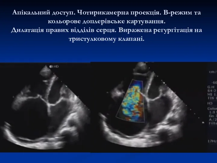 Апікальний доступ. Чотирикамерна проекція. В-режим та кольорове доплерівське картування. Дилатація