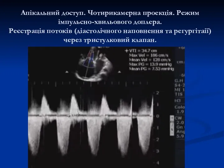 Апікальний доступ. Чотирикамерна проекція. Режим імпульсно-хвильового доплера. Реєстрація потоків (діастолічного наповнення та регургітаії) через тристулковий клапан.