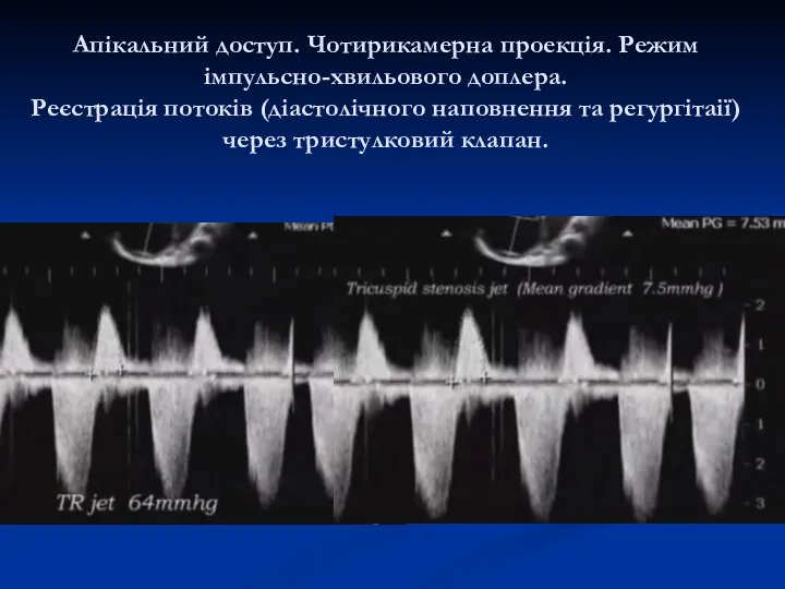 Апікальний доступ. Чотирикамерна проекція. Режим імпульсно-хвильового доплера. Реєстрація потоків (діастолічного наповнення та регургітаії) через тристулковий клапан.