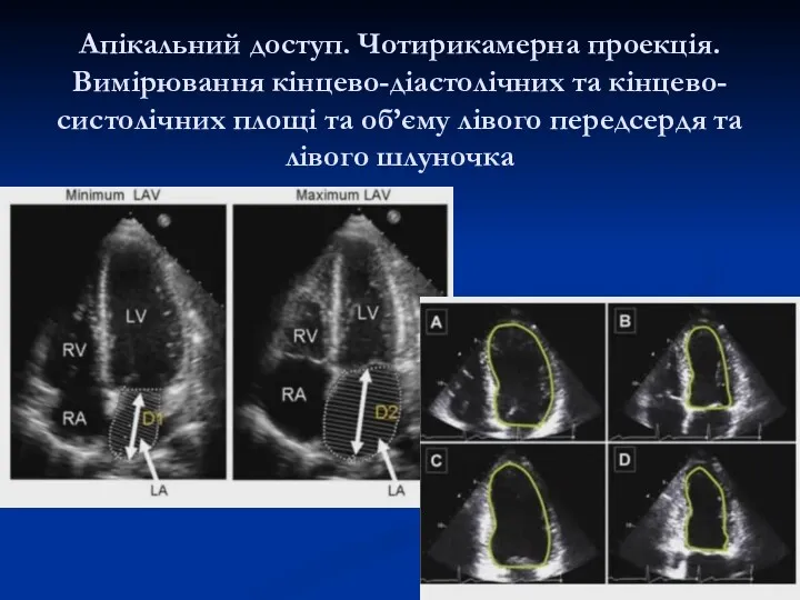 Апікальний доступ. Чотирикамерна проекція. Вимірювання кінцево-діастолічних та кінцево-систолічних площі та об’єму лівого передсердя та лівого шлуночка