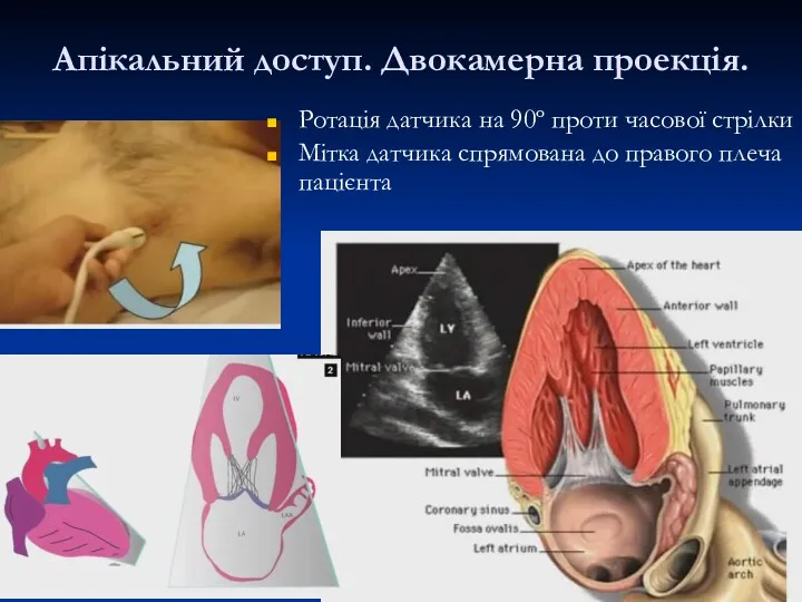 Апікальний доступ. Двокамерна проекція. Ротація датчика на 90º проти часової