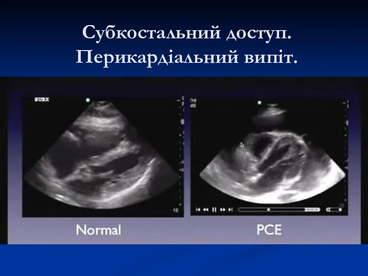 Субкостальний доступ. Перикардіальний випіт.