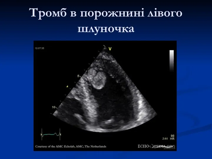 Тромб в порожнині лівого шлуночка