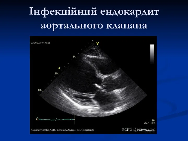 Інфекційний ендокардит аортального клапана