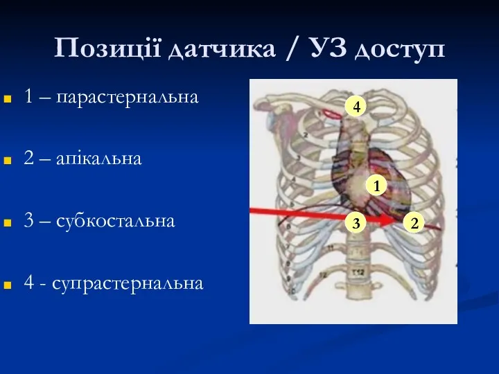 Позиції датчика / УЗ доступ 1 – парастернальна 2 –