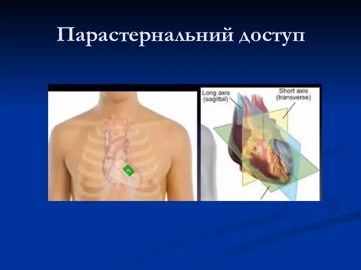 Парастернальний доступ