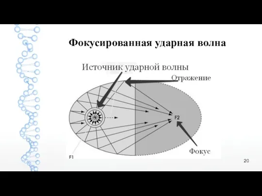 Фокусированная ударная волна