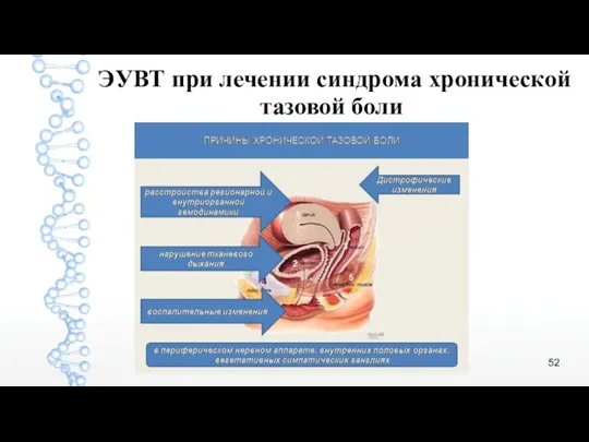 ЭУВТ при лечении синдрома хронической тазовой боли