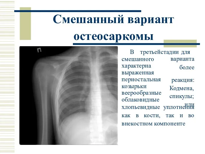 Смешанный вариант остеосаркомы В третьей стадии для смешанного характерна выраженная