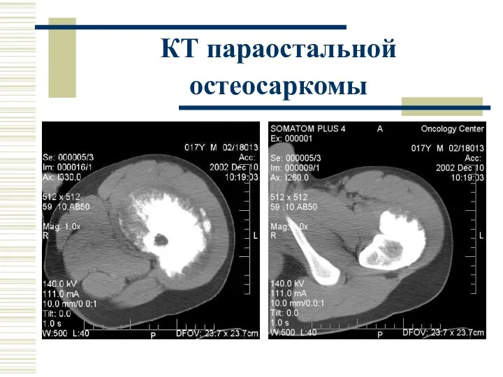 КТ параостальной остеосаркомы