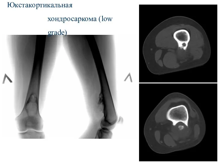 Юкстакортикальная хондросаркома (low grade)