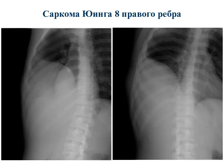 Саркома Юинга 8 правого ребра