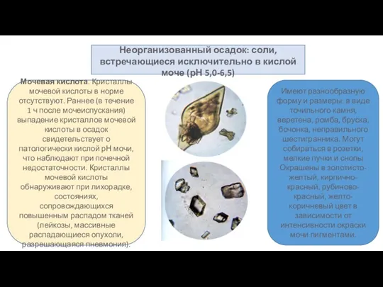 Неорганизованный осадок: соли, встречающиеся исключительно в кислой моче (рН 5,0-6,5)