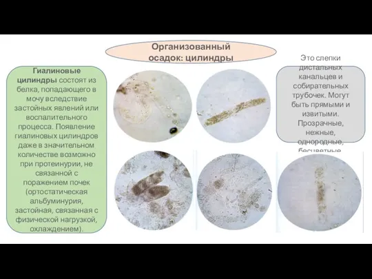 Организованный осадок: цилиндры Гиалиновые цилиндры состоят из белка, попадающего в