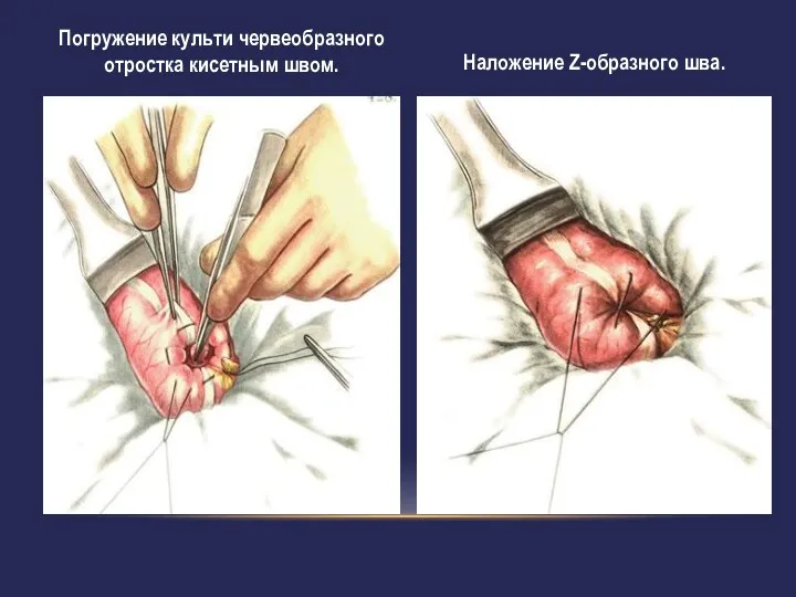 Наложение Z-образного шва. Погружение культи червеобразного отростка кисетным швом.