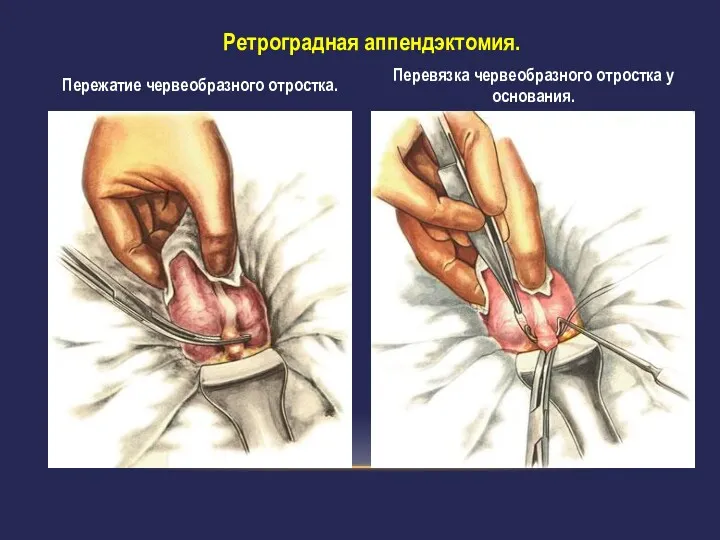 Ретроградная аппендэктомия. Пережатие червеобразного отростка. Перевязка червеобразного отростка у основания.