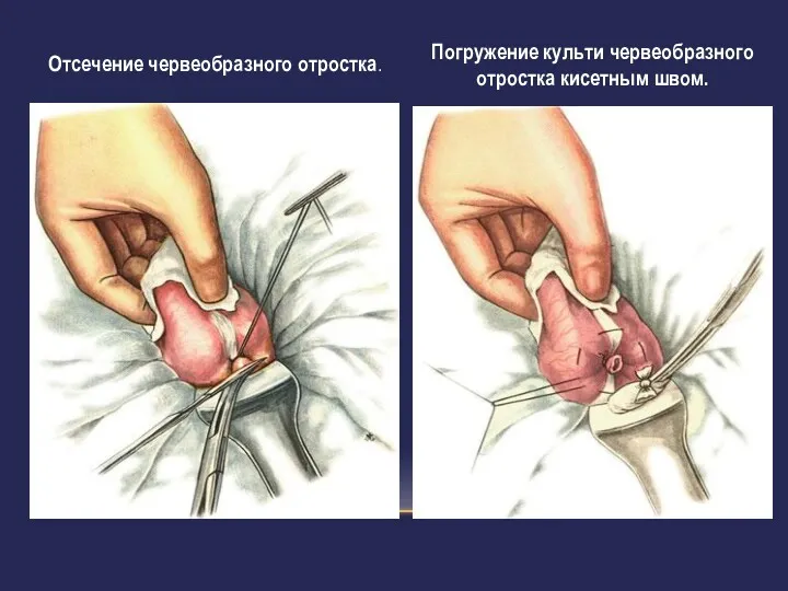 Отсечение червеобразного отростка. Погружение культи червеобразного отростка кисетным швом.