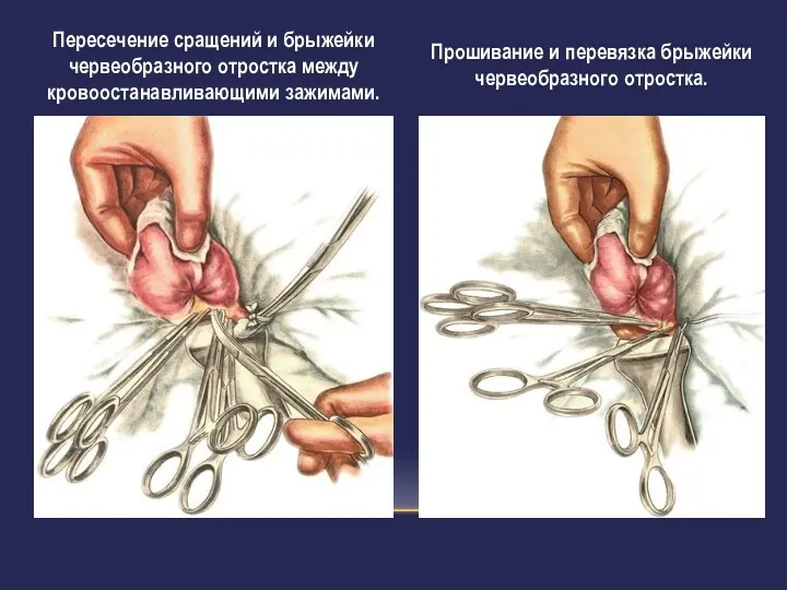 Пересечение сращений и брыжейки червеобразного отростка между кровоостанавливающими зажимами. Прошивание и перевязка брыжейки червеобразного отростка.