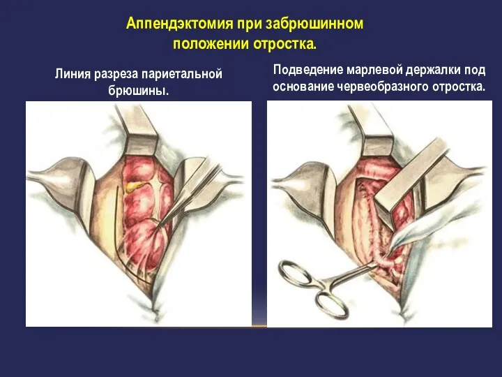 Аппендэктомия при забрюшинном положении отростка. Линия разреза париетальной брюшины. Подведение марлевой держалки под основание червеобразного отростка.