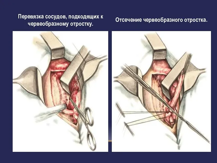 Перевязка сосудов, подходящих к червеобразному отростку. Отсечение червеобразного отростка.