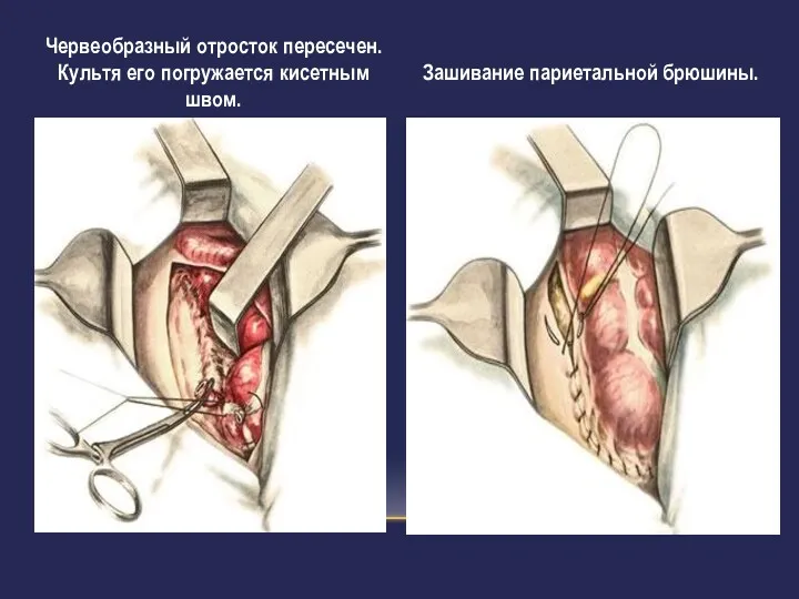 Червеобразный отросток пересечен. Культя его погружается кисетным швом. Зашивание париетальной брюшины.