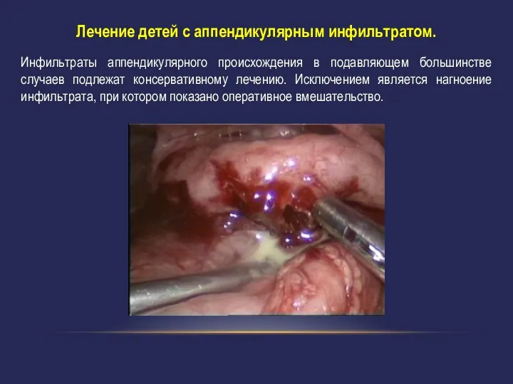 Лечение детей с аппендикулярным инфильтратом. Инфильтраты аппендикулярного происхождения в подавляющем