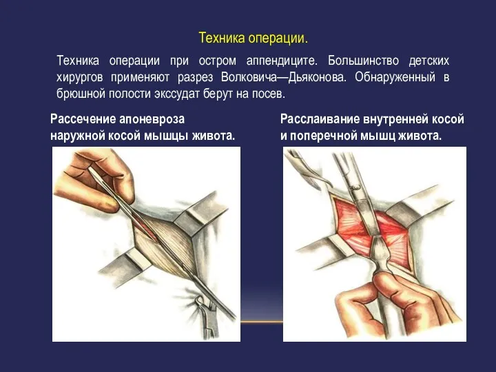 Техника операции. Техника операции при остром аппендиците. Большинство детских хирургов применяют разрез Волковича—Дьяконова.