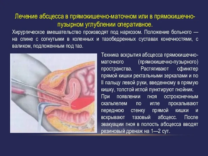 Лечение абсцесса в прямокишечно-маточном или в прямокишечно-пузырном углублении оперативное. Хирургическое вмешательство производят под