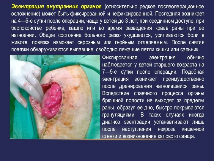 Эвентрация внутренних органов (относительно редкое послеоперационное осложнение) может быть фиксированной и нефиксированной. Последняя