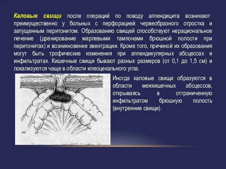 Каловые свищи после операций по поводу аппендицита возникают преимущественно у больных с перфорацией