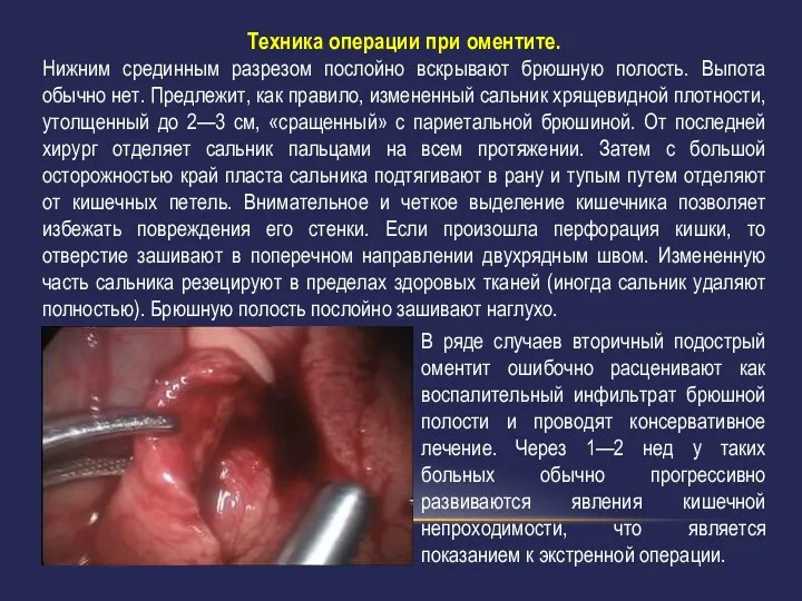 Техника операции при оментите. Нижним срединным разрезом послойно вскрывают брюшную