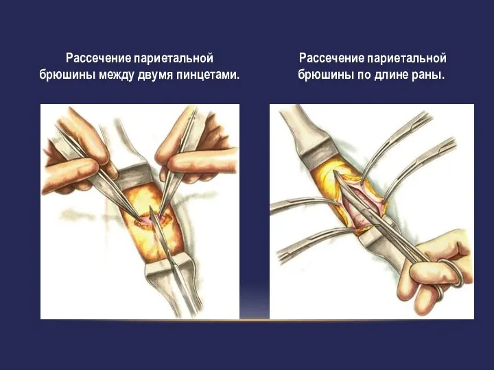 Рассечение париетальной брюшины между двумя пинцетами. Рассечение париетальной брюшины по длине раны.
