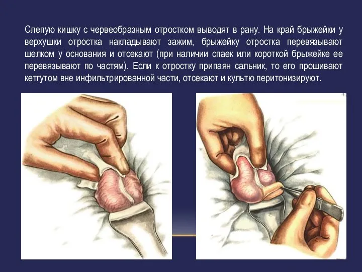 Слепую кишку с червеобразным отростком выводят в рану. На край брыжейки у верхушки