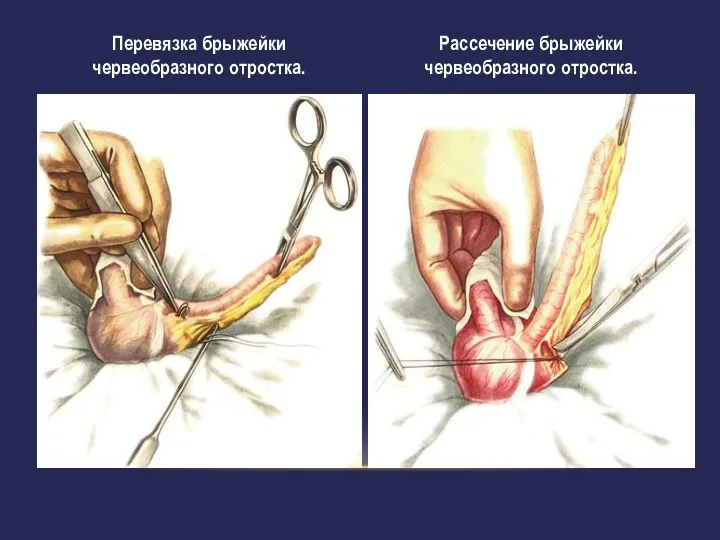 Рассечение брыжейки червеобразного отростка. Перевязка брыжейки червеобразного отростка.