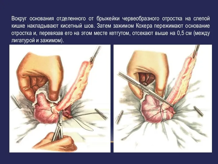 Вокруг основания отделенного от брыжейки червеобразного отростка на слепой кишке накладывают кисетный шов.