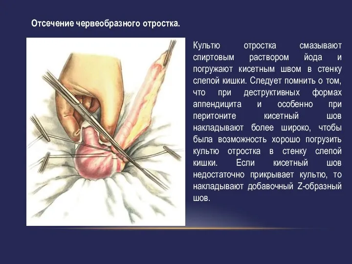 Культю отростка смазывают спиртовым раствором йода и погружают кисетным швом в стенку слепой