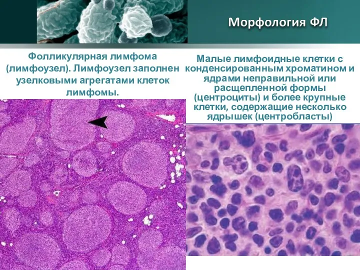 Фолликулярная лимфома (лимфоузел). Лимфоузел заполнен узелковыми агрегатами клеток лимфомы. Малые лимфоидные клетки с