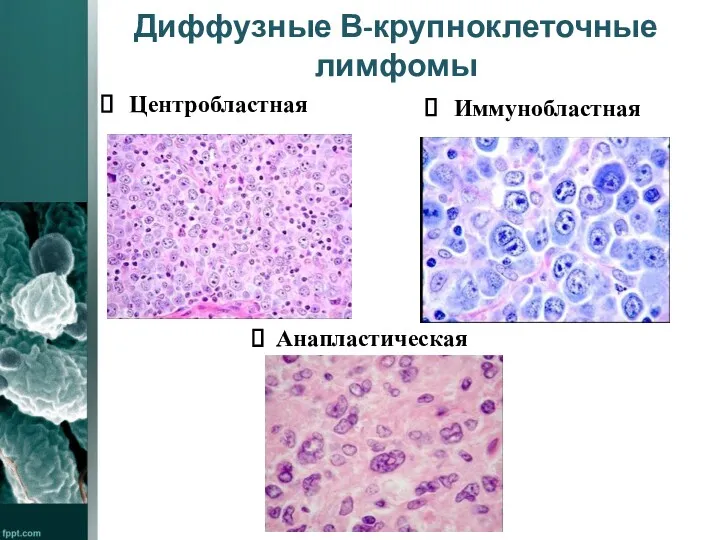 Диффузные В-крупноклеточные лимфомы Центробластная Анапластическая Иммунобластная