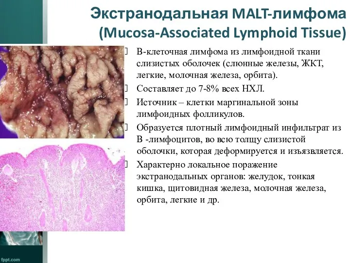 Экстранодальная MALT-лимфома (Mucosa-Associated Lymphoid Tissue) В-клеточная лимфома из лимфоидной ткани слизистых оболочек (слюнные