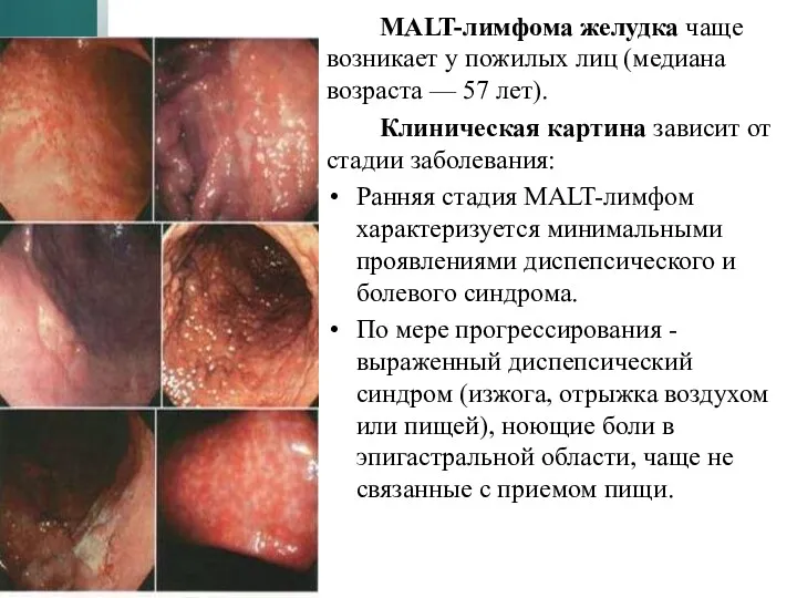 MALT-лимфома желудка чаще возникает у пожилых лиц (медиана возраста — 57 лет). Клиническая