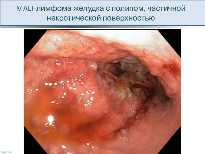 MALT-лимфома желудка с полипом, частичной некротической поверхностью