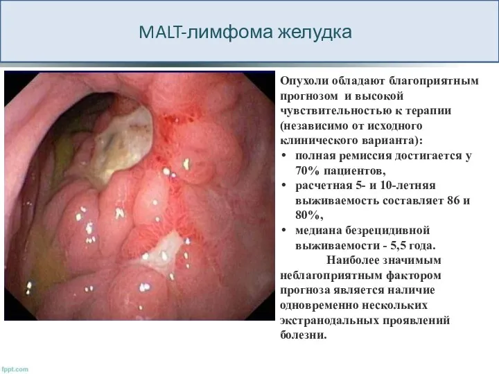 MALT-лимфома желудка Опухоли обладают благоприятным прогнозом и высокой чувствительностью к терапии (независимо от