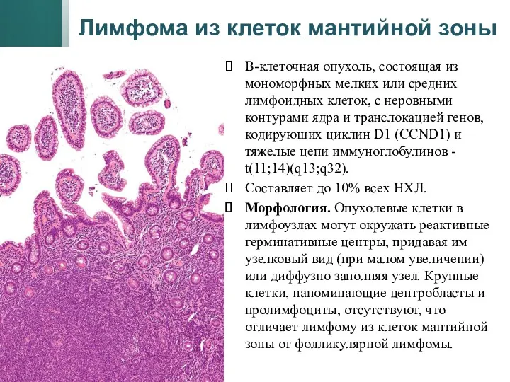 Лимфома из клеток мантийной зоны В-клеточная опухоль, состоящая из мономорфных мелких или средних