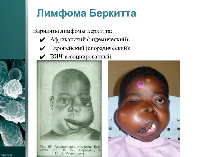 Лимфома Беркитта Варианты лимфомы Беркитта: Африканский (эндемический); Европейский (спорадический); ВИЧ-ассоциированный.