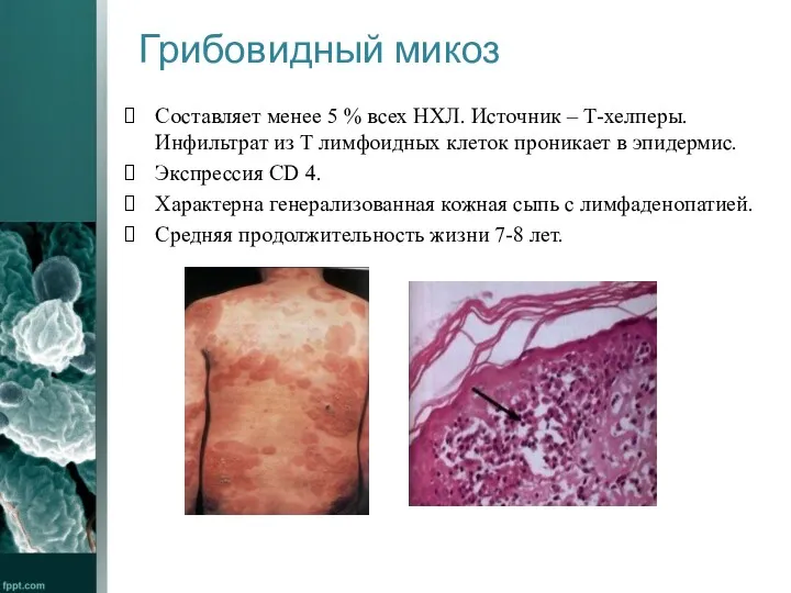 Грибовидный микоз Составляет менее 5 % всех НХЛ. Источник – Т-хелперы. Инфильтрат из