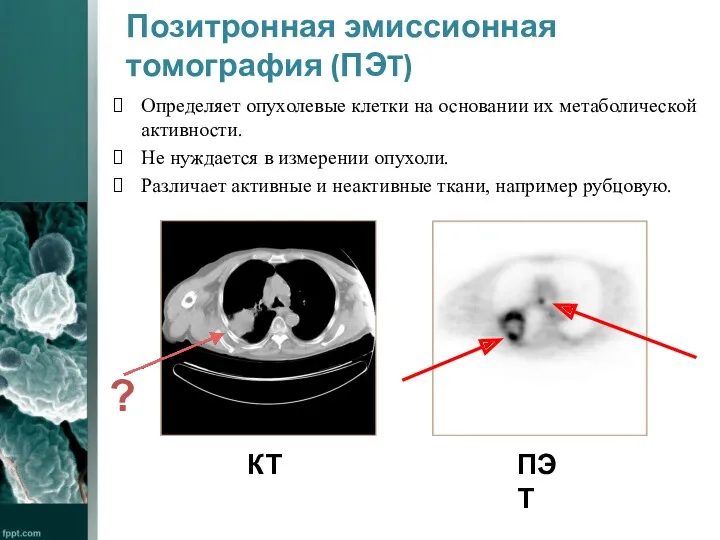 Позитронная эмиссионная томография (ПЭT) Определяет опухолевые клетки на основании их метаболической активности. Не