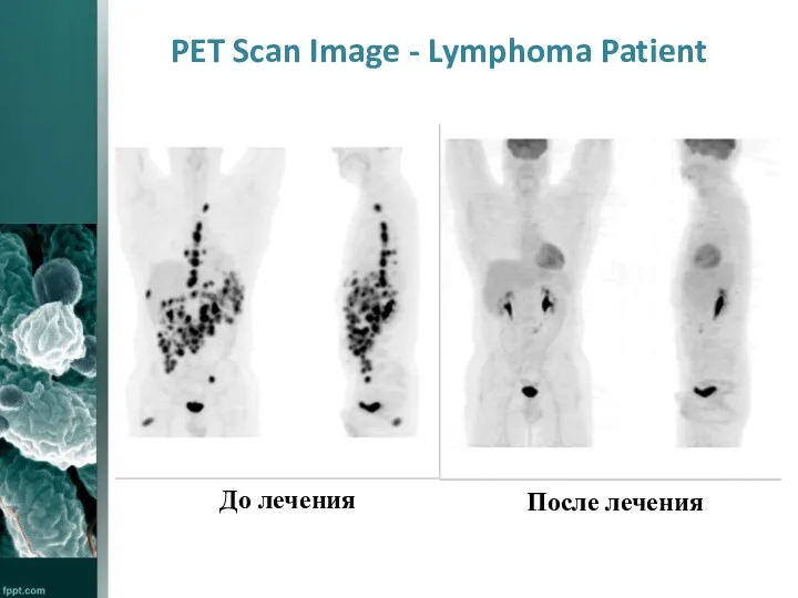 PET Scan Image - Lymphoma Patient До лечения После лечения