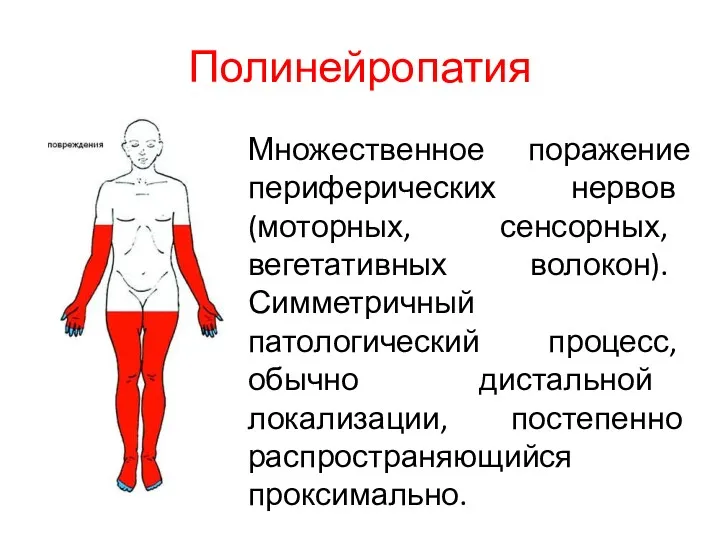 Полинейропатия Множественное поражение периферических нервов (моторных, сенсорных, вегетативных волокон). Симметричный